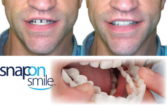 ✨ ¡Oferta 3x1! Carillas Dentales Snap On Smile: Sonrisa Perfecta al Instante 😁